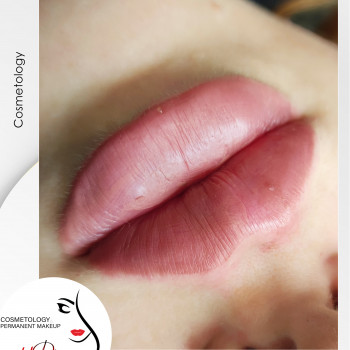 Аугментація губ (збільшення губ) від косметолога Наталії Філь

   