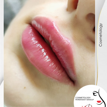 Аугментація губ (збільшення губ) від косметолога Наталії Філь

   