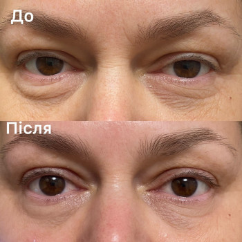 Моделюючий масаж обличчя

Total lift

6 cеансів