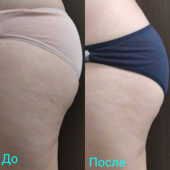 Антицелюлітний масаж тіла

10 сеансів