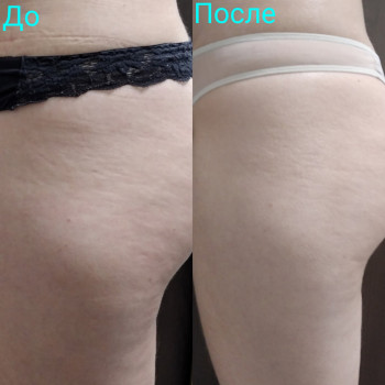 Антицелюлітний масаж тіла

10 сеансів