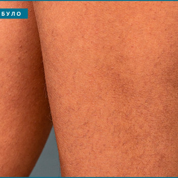 Лазерна епіляція Комплекс MIDI
                    Салон краси КОСМЕТ Житомир