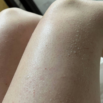 Відразу після процедури