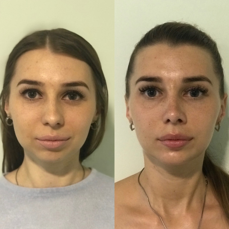 Ринопластика+Ментопластика #підборіддя #ніс #ментопластика, фото -  