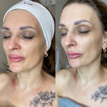 Результат відразу після ферментотерапії (anti age)