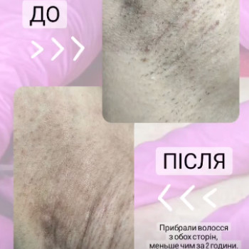 Фото из портфолио мастера Алина (электролог, Киев)