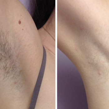 Лазерная эпиляция; лазерна епіляція
                    Мастер эпиляции Янітта Киев