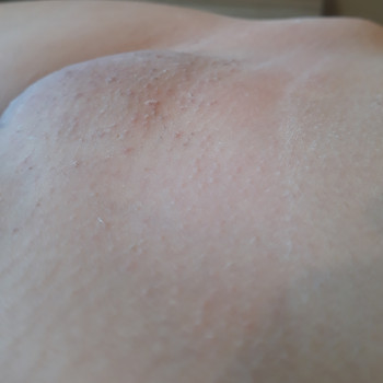 Після процедури