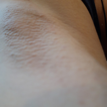 Після процедури