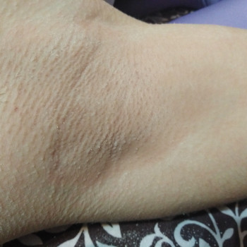 Підпашки після процедури