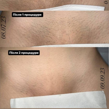 лазерная эпиляция бикини