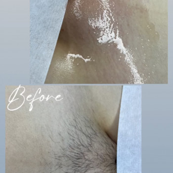 Глибоке бікіні (до/після)