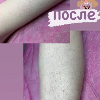 Ніжки (до/після)