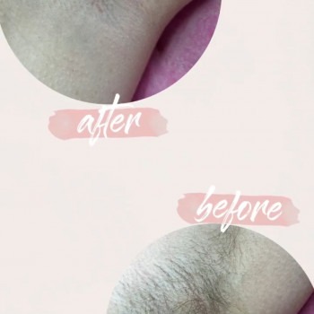 Підпахви (до/після)