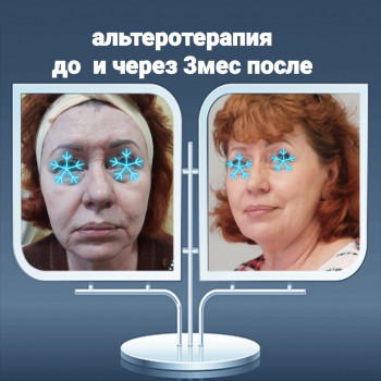  
 
До и после 3мес
Smas Ulthera system
    #