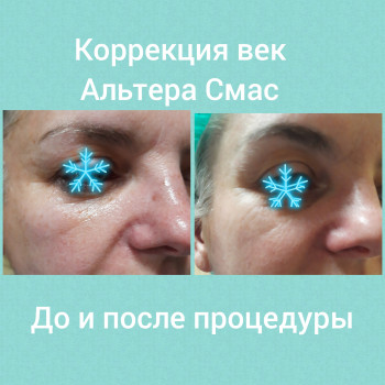  
Коррекция орбитальной области
    #