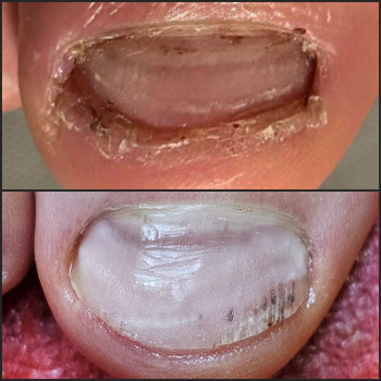 Работа с вросшим ногтем
                    Подолог Ольга Бровары