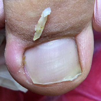 Работа с вросшим ногтем
                    Подолог Ольга Бровары