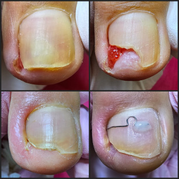 Работа с вросшим ногтем
                    Подолог Ольга Бровары