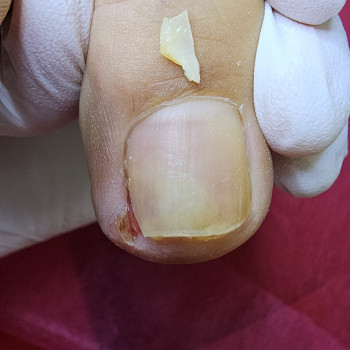 Работа с вросшим ногтем
                    Подолог Ольга Бровары