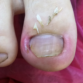 Работа с вросшим ногтем
                    Подолог Ольга Бровары