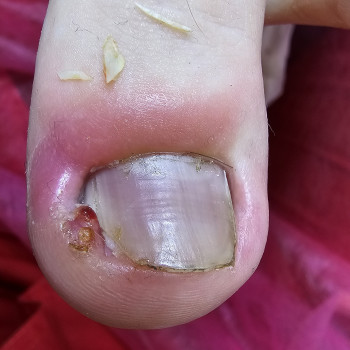 Работа с вросшим ногтем
                    Подолог Ольга Бровары