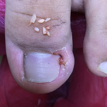 Работа с вросшим ногтем
                    Подолог Ольга Бровары