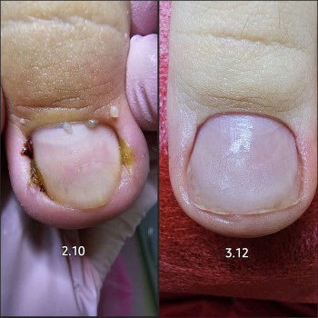 Работа с вросшим ногтем
                    Подолог Ольга Бровары