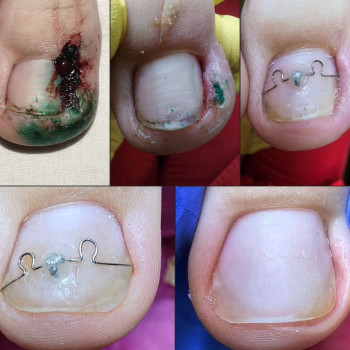 Работа с вросшим ногтем
                    Подолог Ольга Бровары