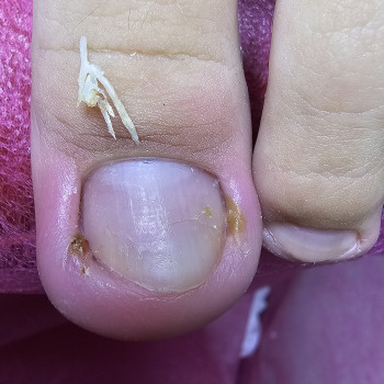 Работа с вросшим ногтем
                    Подолог Ольга Бровары