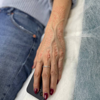 Якщо турбує сухість рук, то біоревіталізація може допомогти.