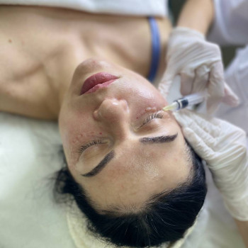 Біоревіталізація зони навколо очей. Препарат Matrix. Ідеально працює зі шкірою навколо очей