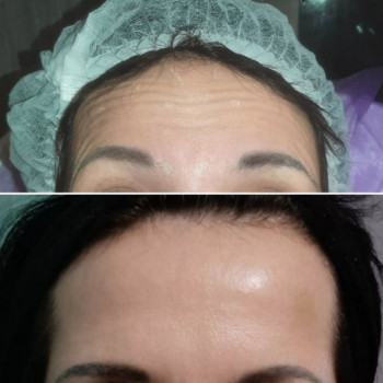  #Ботулінотерапія