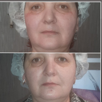  #Rf ліфтинг #кріотерапія(після 1ї процедури)