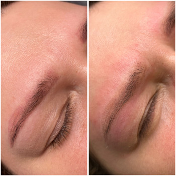 Лазерне видалення
                    Бровист Ксения Николаев