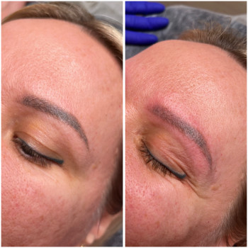 Лазерне видалення
                    Бровист Ксения Николаев