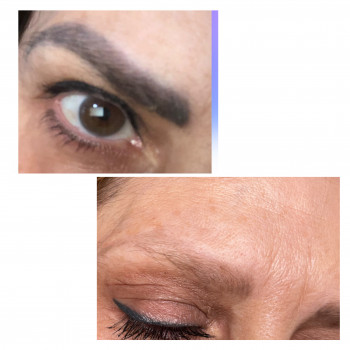 Лазерне видалення
                    Бровист Ксения Николаев