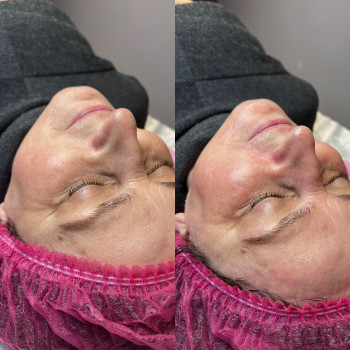 Карбоксітерапія