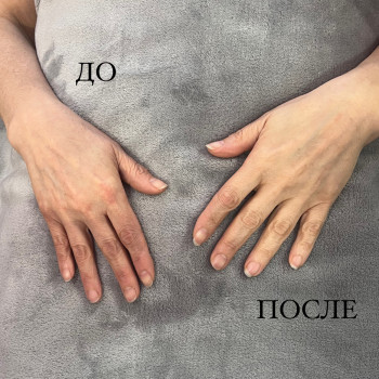 Мікронідлінг рук