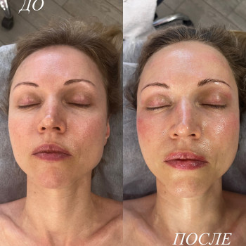 Мікронідлінг на зволоження та сяяня