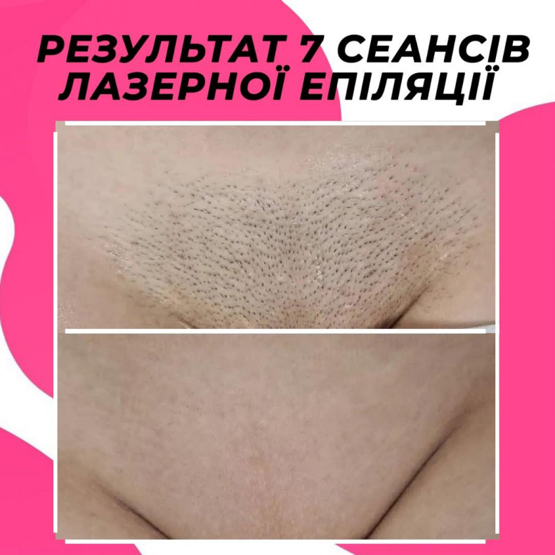 Лазерна епіляція бікіні, результат 7 сеансів.  #лазернаепіляція, фото -  