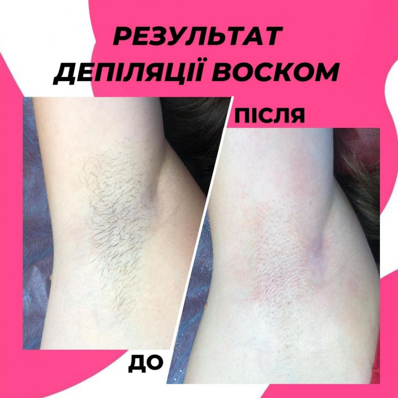Результат депіляції пахв воском #восковадепіляція, фото -  