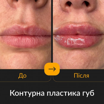 збільшення губ