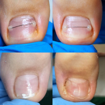 Корекція нігтя
    
 
 
 