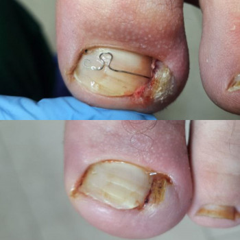 Врослий ніготь
    
 
 
 