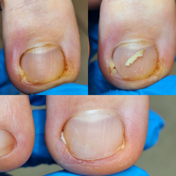 Врослий ніготь
    
 
 
 