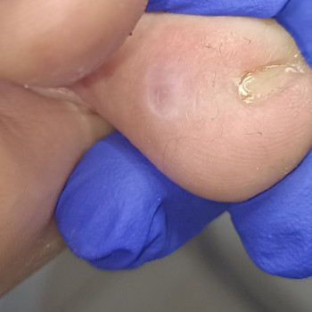 Видалення мозолі