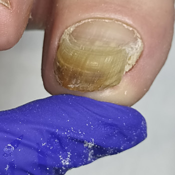 Лікування грибкових нігтів, оніхогрифозу та таке інше