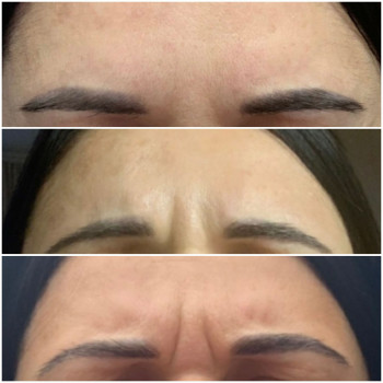 Ботулотоксин в роботі