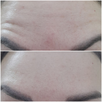 Ботулінотерапія верхньої третини обличчя
                    Косметолог Ірина Луцк